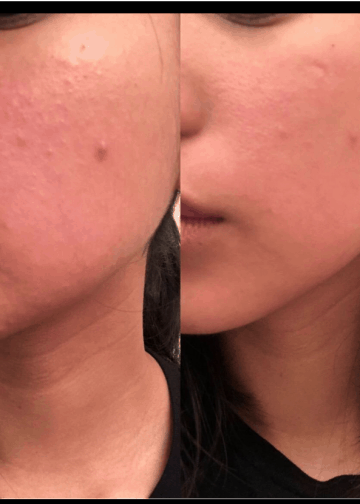 The photo shows the profile of a woman before and after using a microneedling roller. The image on the left shows some acne and irritation on her cheek. On the right, much of that acne appears to be gone. 