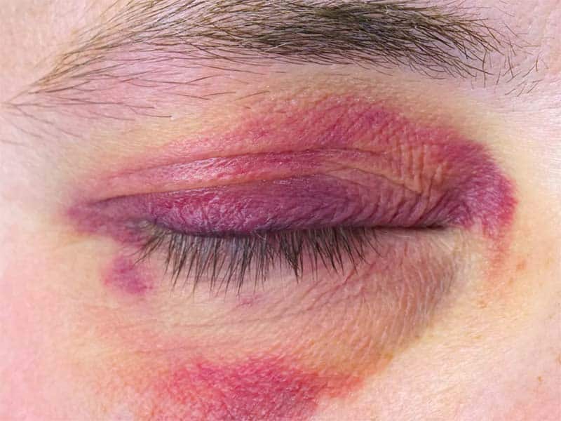 Black Eye Healing Stages