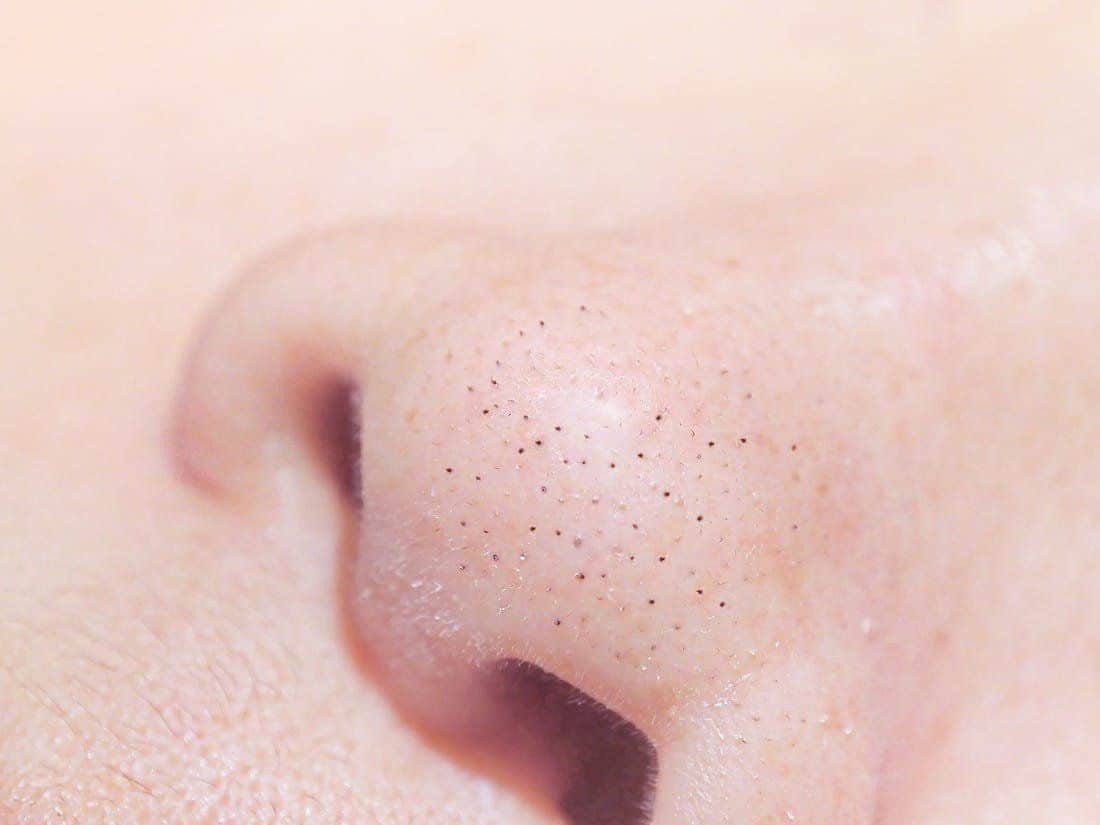 Blackheads in the Nose, Causes, Prevention, and Treatment
