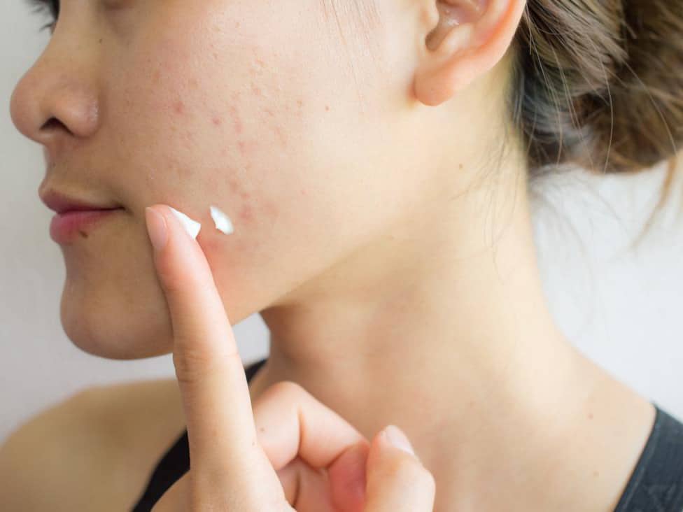 Causes of Acne Marks