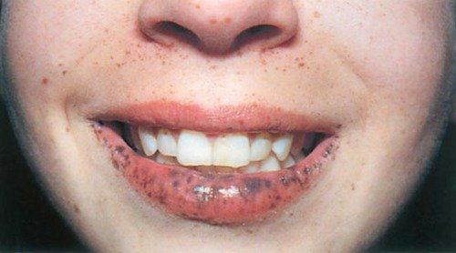 Causes of Black Spots on Lips