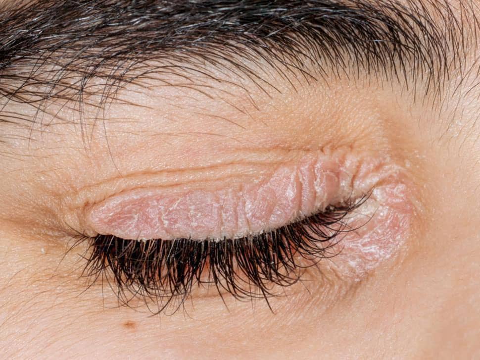 Causes of dry skin around the eyes