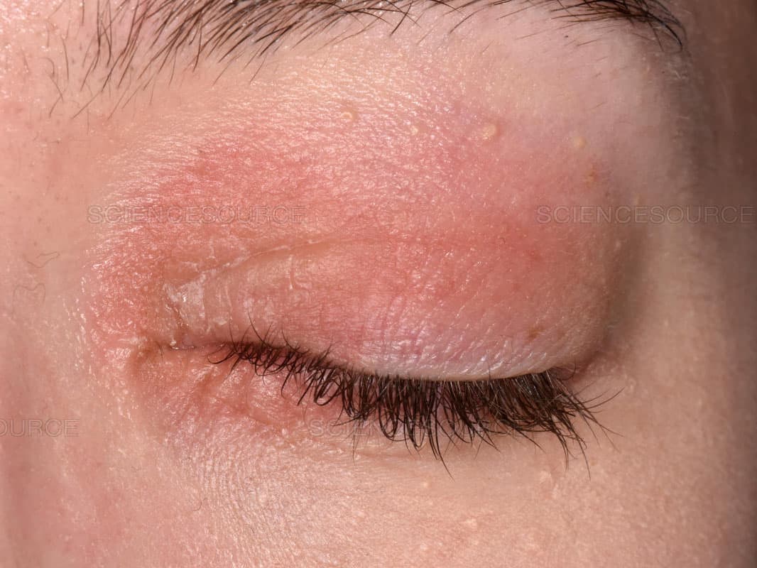 Eczema around eyes