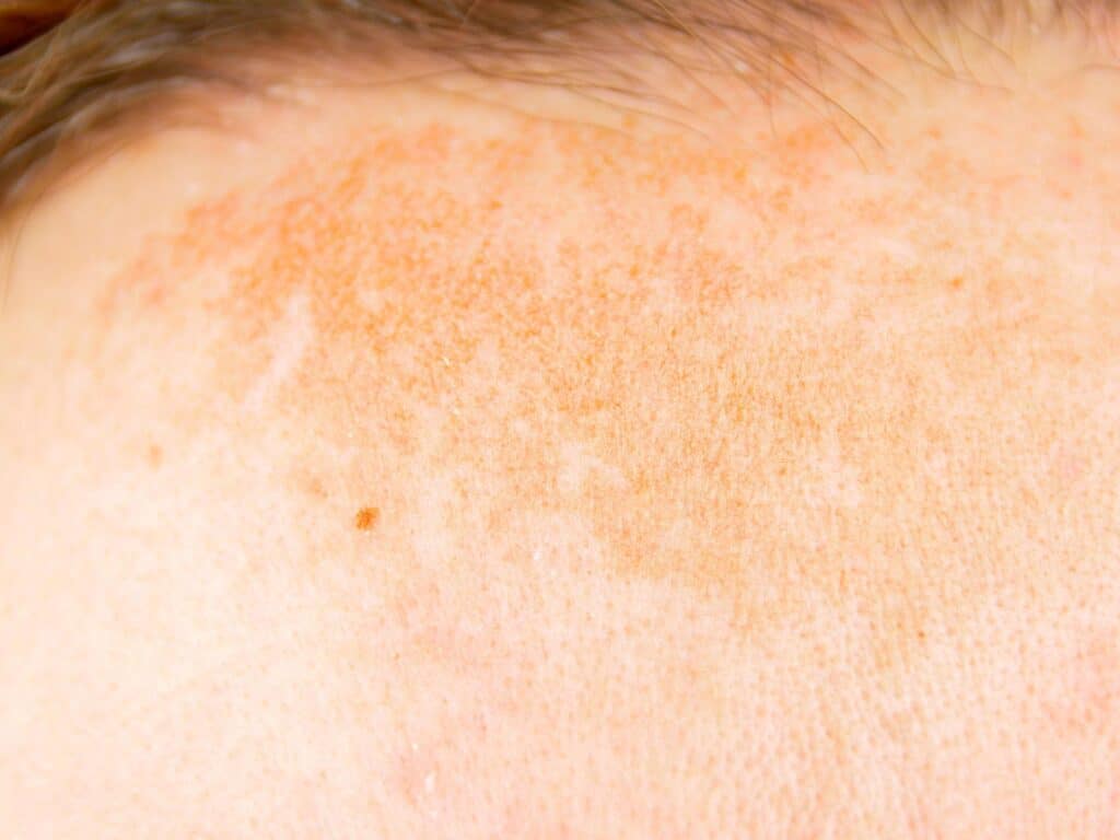 Brown Patches On Skin, Spots: Causes, Get Rid, Remedies, Treatment