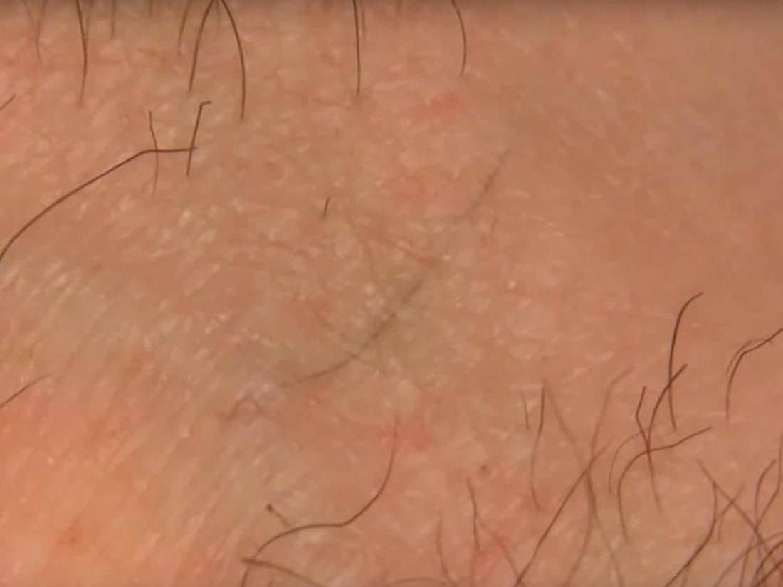 Get rid of the ingrown hairs by freeing them