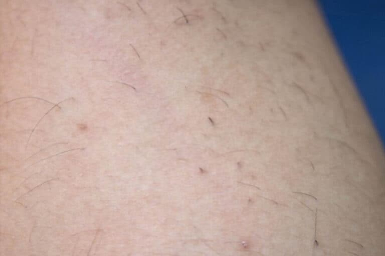 Ingrown Hair On Legs Causes Symptoms Home Remedies And Treatment