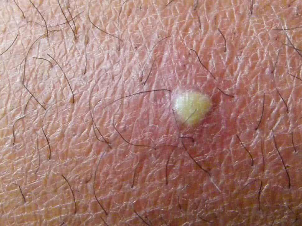 Ingrown hair cyst, boil and bump under the skin