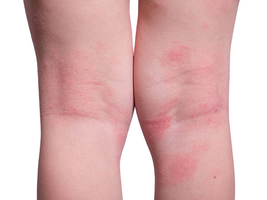 Is eczema contagious – Can eczema spread