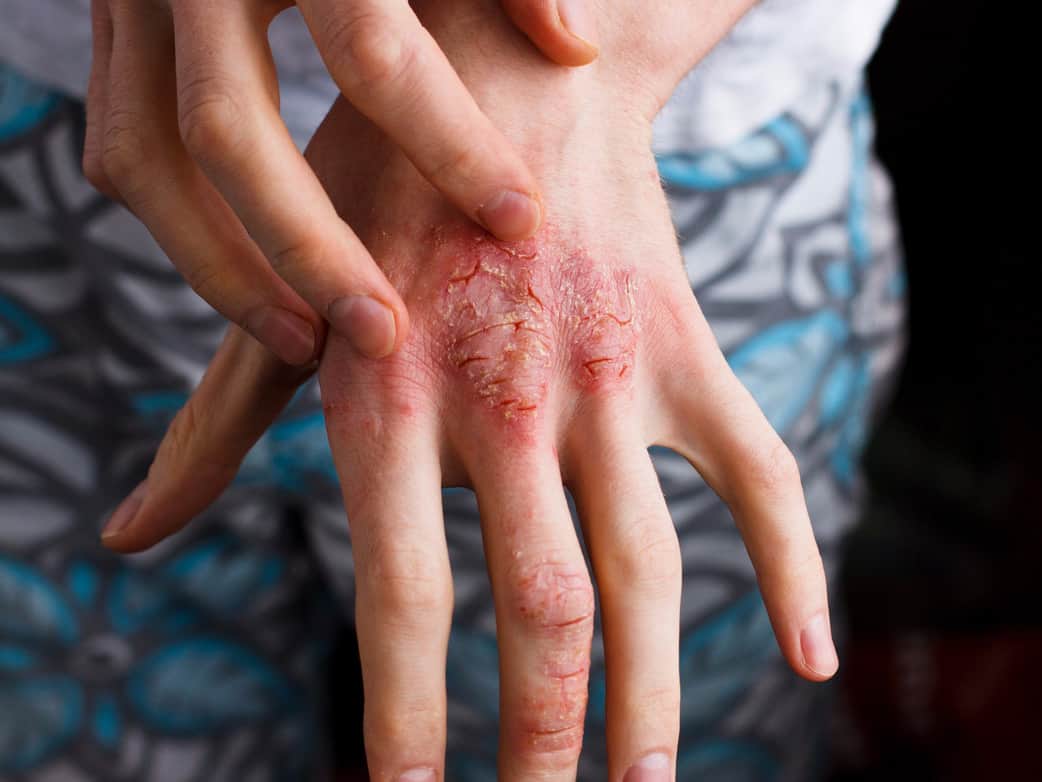 Is eczema curable?
