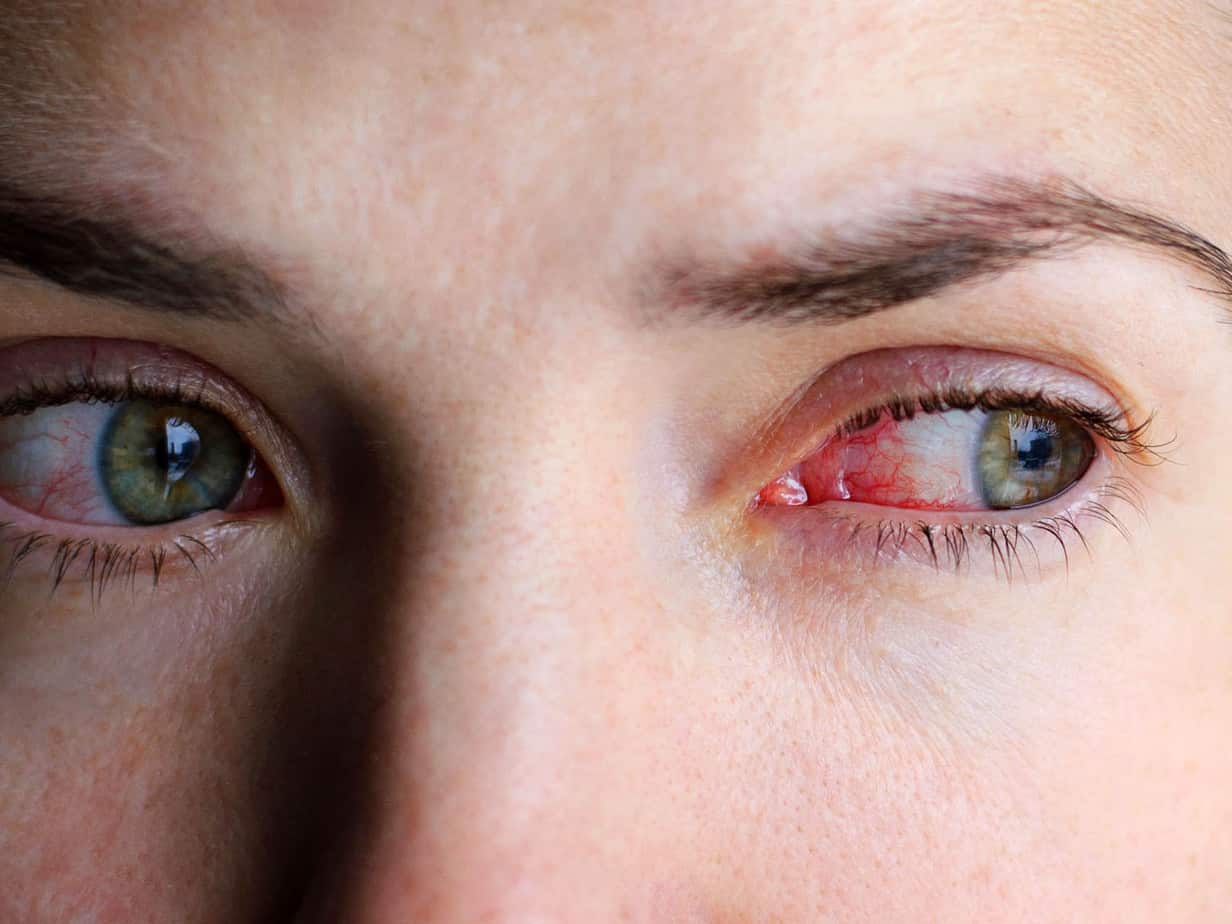 Related symptoms of red eyes