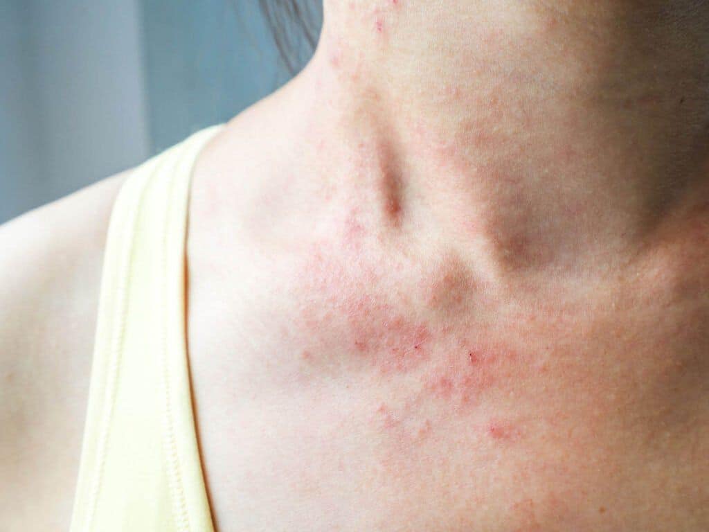 Red Bumps On Skin Rash