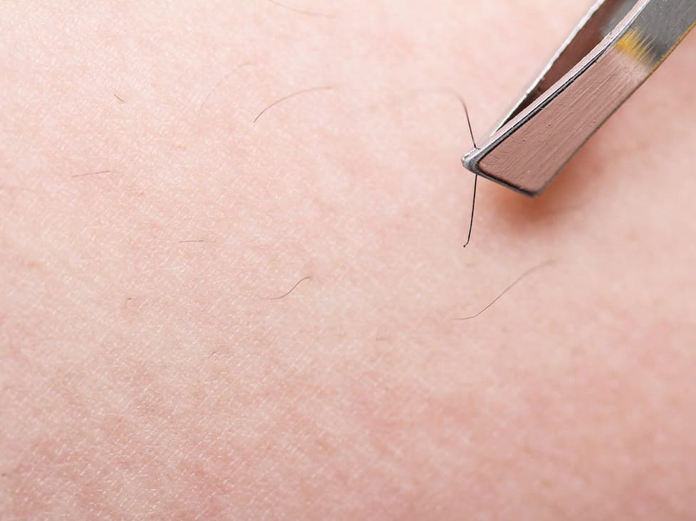 What are the causes of ingrown hair?