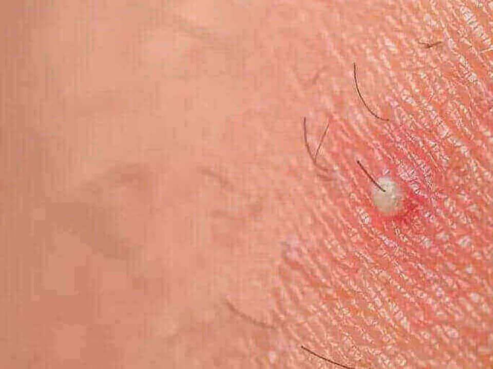 Do not confuse ingrown hair with std or sti infection, an ingrown hair is c...