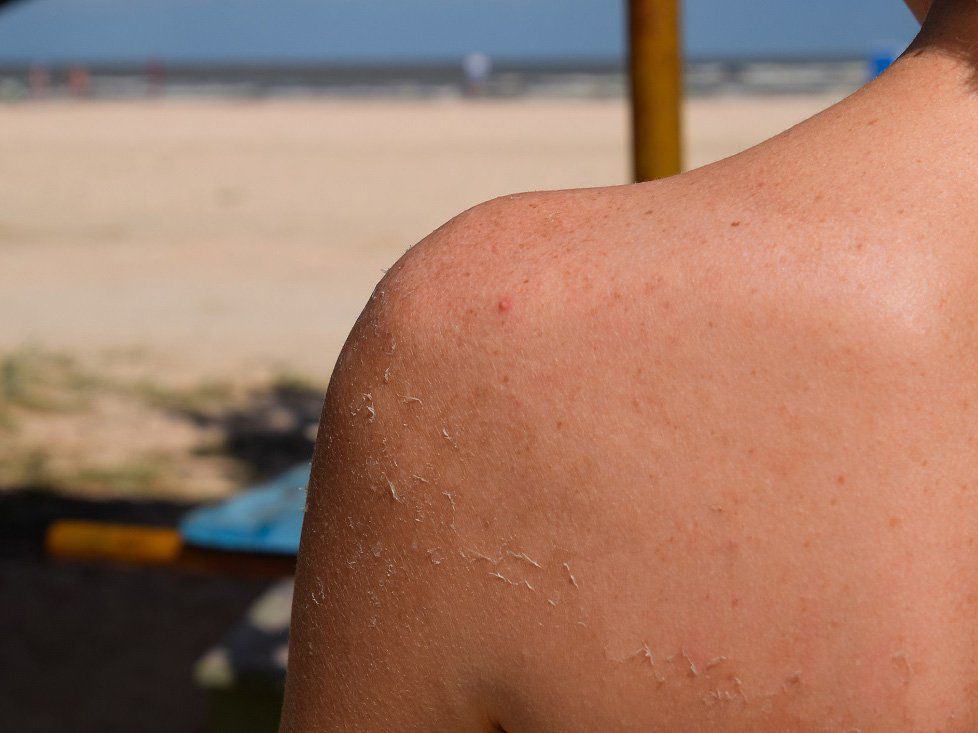 White spots on skin from the sun