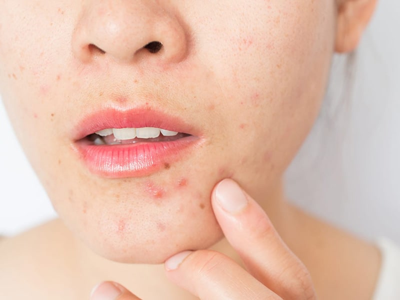 What ingredients cause the skin to purge?